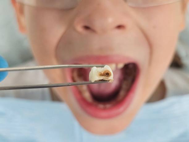 Best Emergency Dental Care for Broken or Chipped Teeth in Townsend, DE